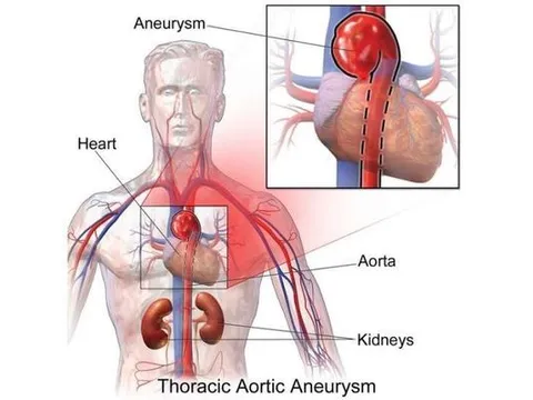 Máy học có thể giúp xác định những người có nguy cơ bị phình động mạch chủ ở ngực
